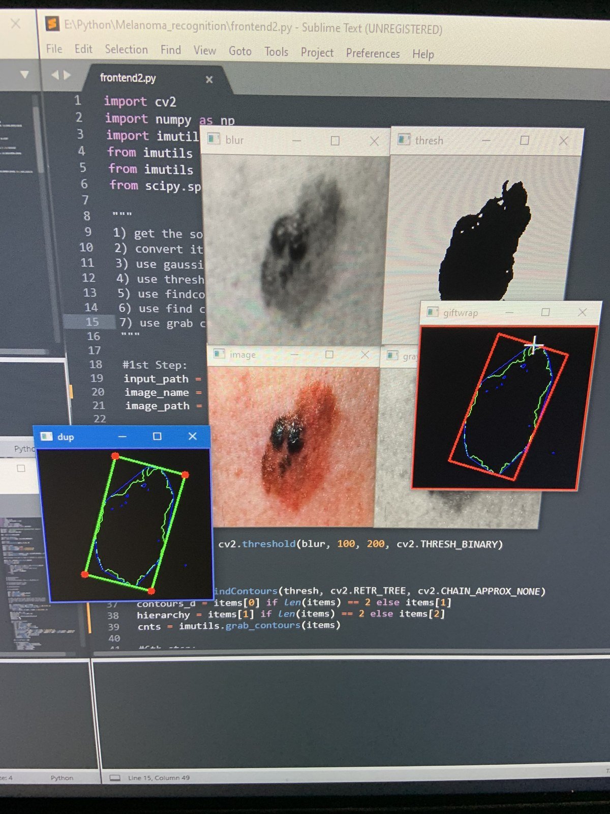 RIDGE CV2 lesion detection code